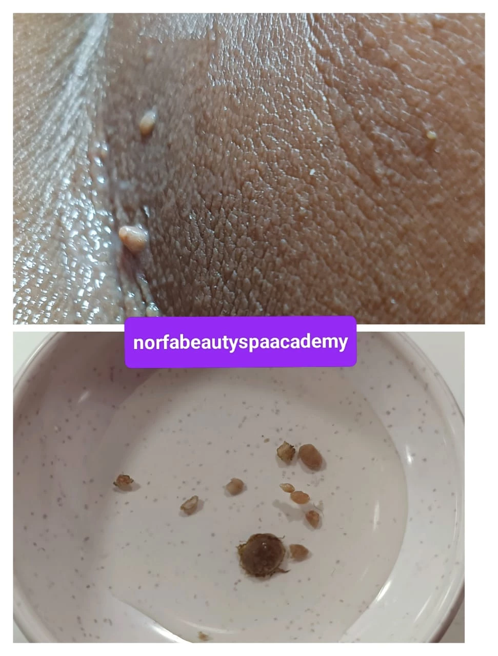 VOUCHER 50% CLASS SKINTAGS REMOVAL